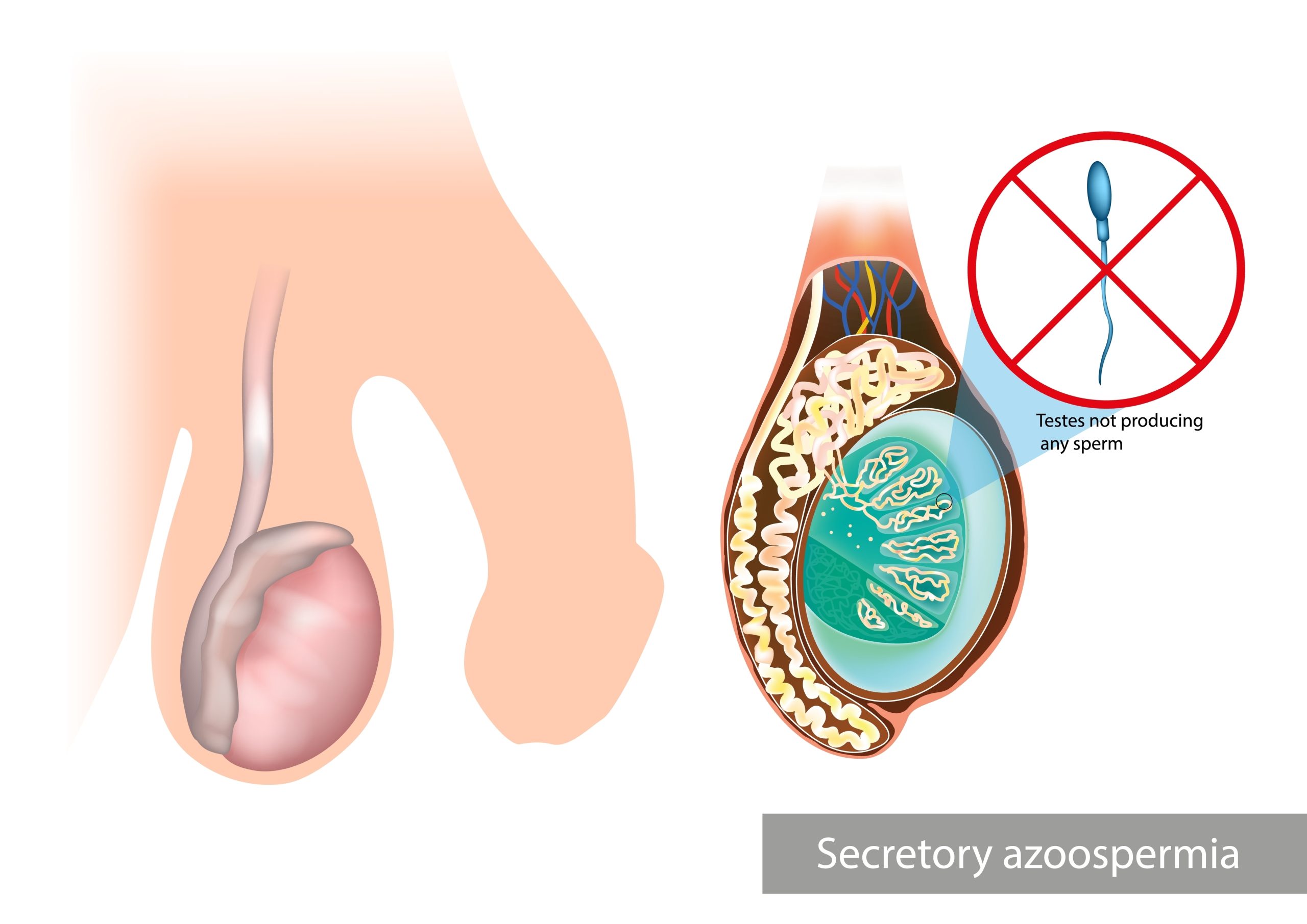Secretory,Or,Non-obstructive,Azoospermia.testes,Not,Producing,Any,Sperm.,No,Production